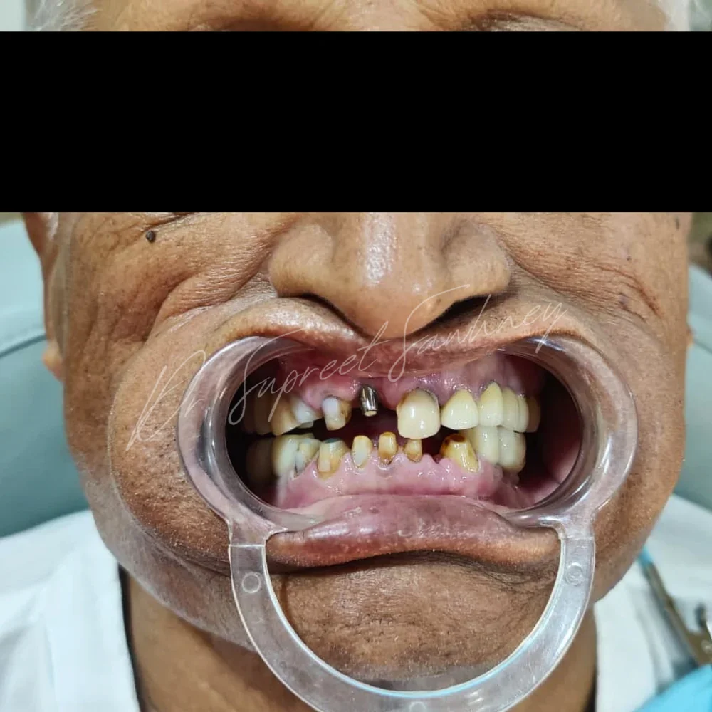 Frontal retracted intraoral photograph before full-arch restorative rehabilitation